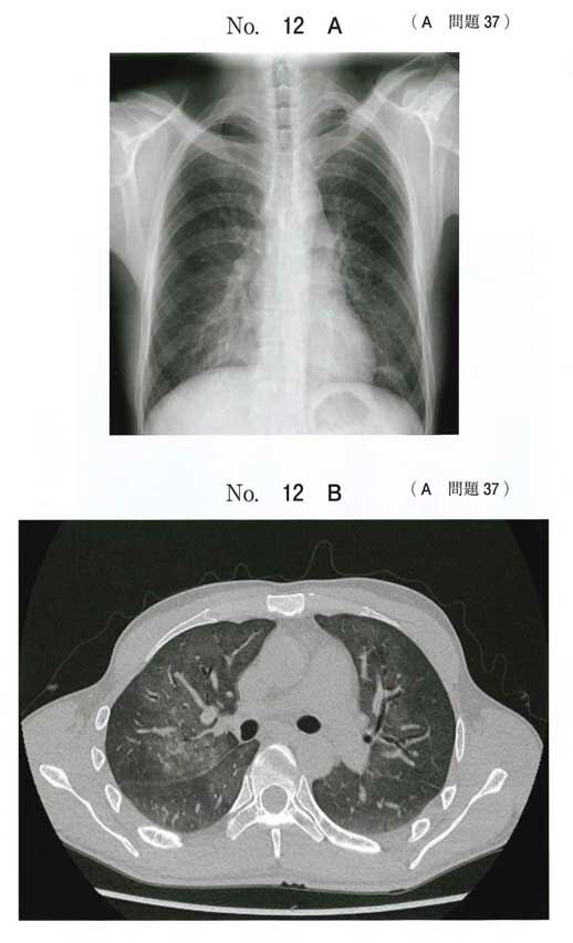 115回医師国家試験問題 A37 ニューモシスチス肺炎 今年の医師国家試験を解いてみました