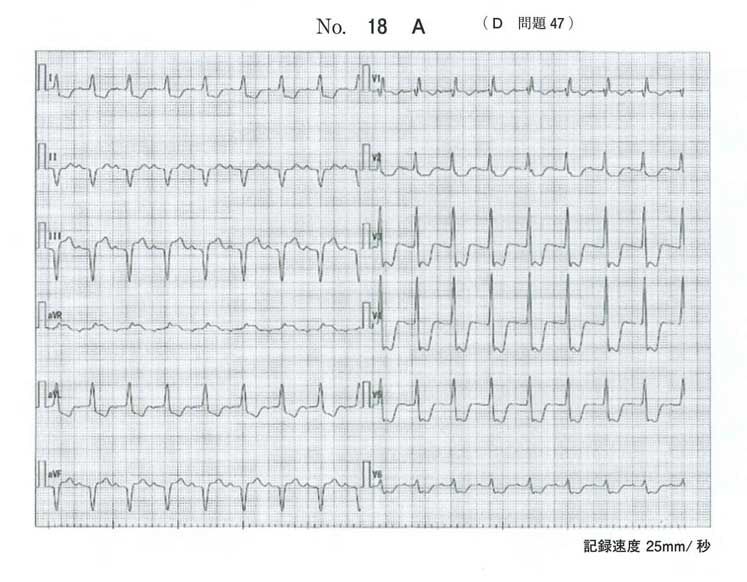 医師国家試験 医師国家試験問題 119D47 急性心筋炎・今年の問題 | 医師国家