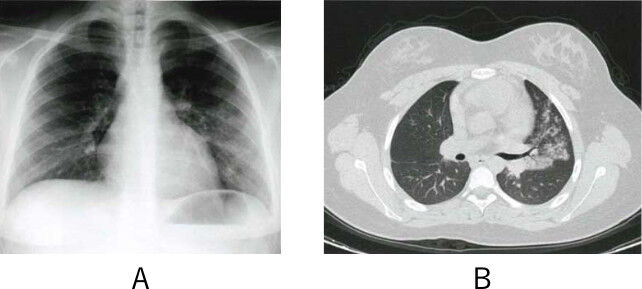 115d23 マイコプラズマ肺炎 今年の医師国家試験を解いてみました