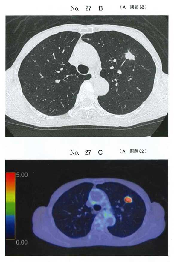 医師国家試験問題を解こう 119A62 肺癌の治療 | 医師国家試験
