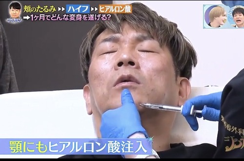 【美容整形】ヒアルロン酸注入　無意味どころか老化を加速させる害だった