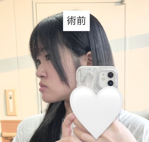 顎変形症の女性が整形手術をした結果ビフォーアフター