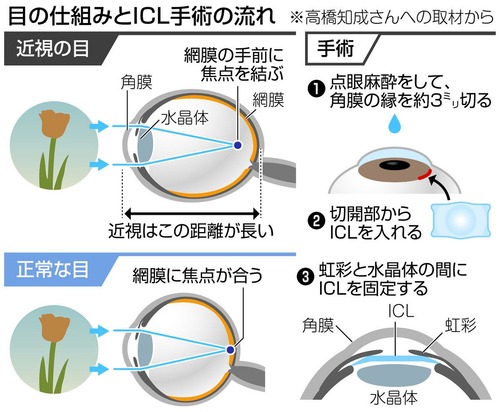 ICL手術怖すぎると話題に