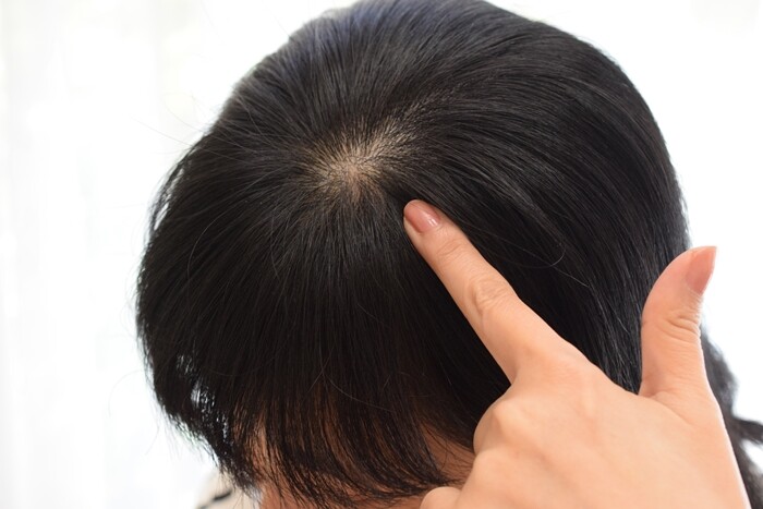 薄毛をしっかりカバー 分け目が目立つ おでこが広い人は フジコdekoシャドウ を使ってみて Happy Go Lucky 心地いい暮らしのコツ Powered By ライブドアブログ