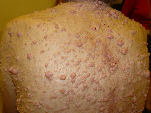 neurofibromatosis_3_041012