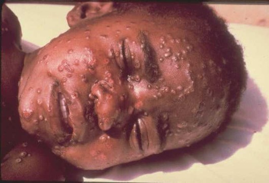 smallpox
