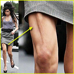amy-winehouse-leg-wonky