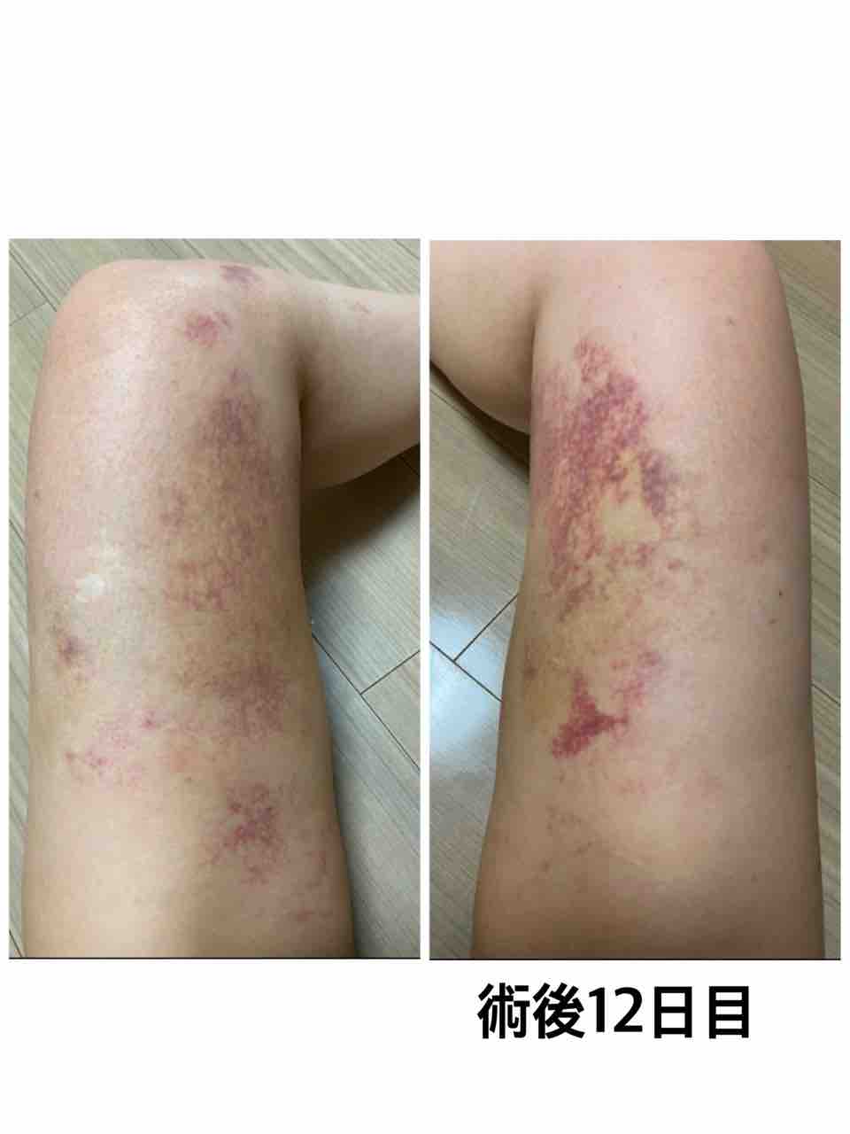 脂肪注入による乳房再建1回目 術後12日目 お胸と太腿がかゆい 乳がん全摘からの脂肪吸引 乳房再建
