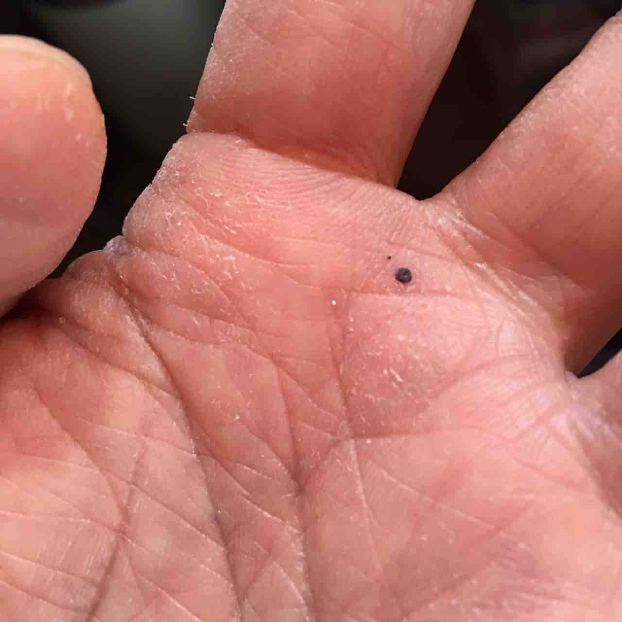 メラノーマじゃなかった 北の手づくりオカリナ