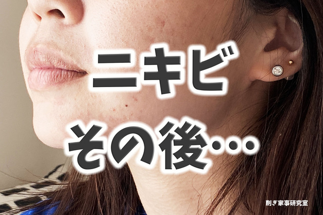 ニキビ6