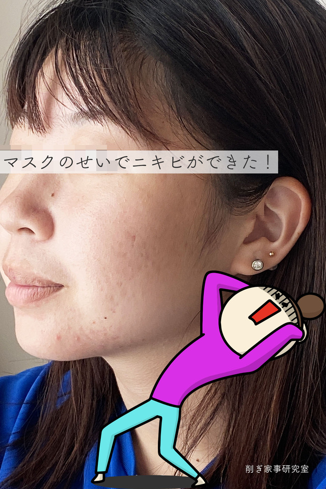 マスクニキビ3