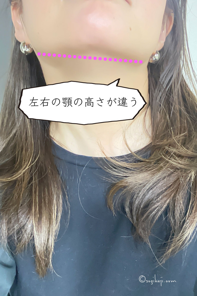 エラボトックス1