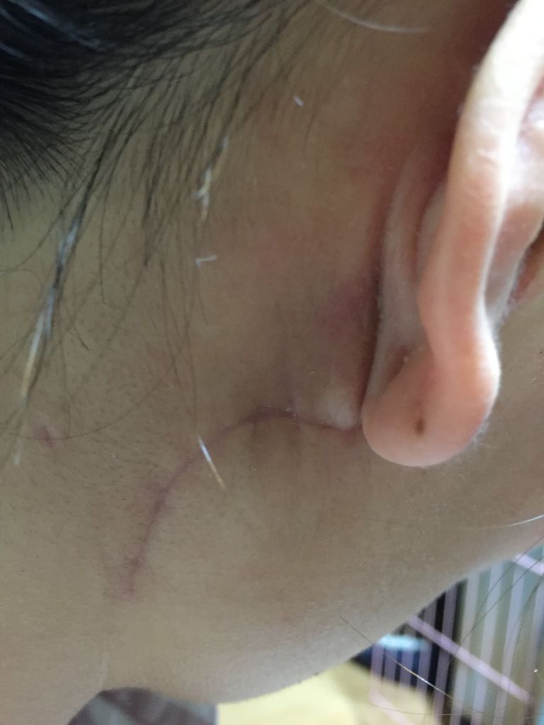 耳下腺腫瘍 術後１ヶ月 唾液漏２３日目 耳の後ろのしわ 耳下腺腫瘍と椎間板ヘルニア 闘病記