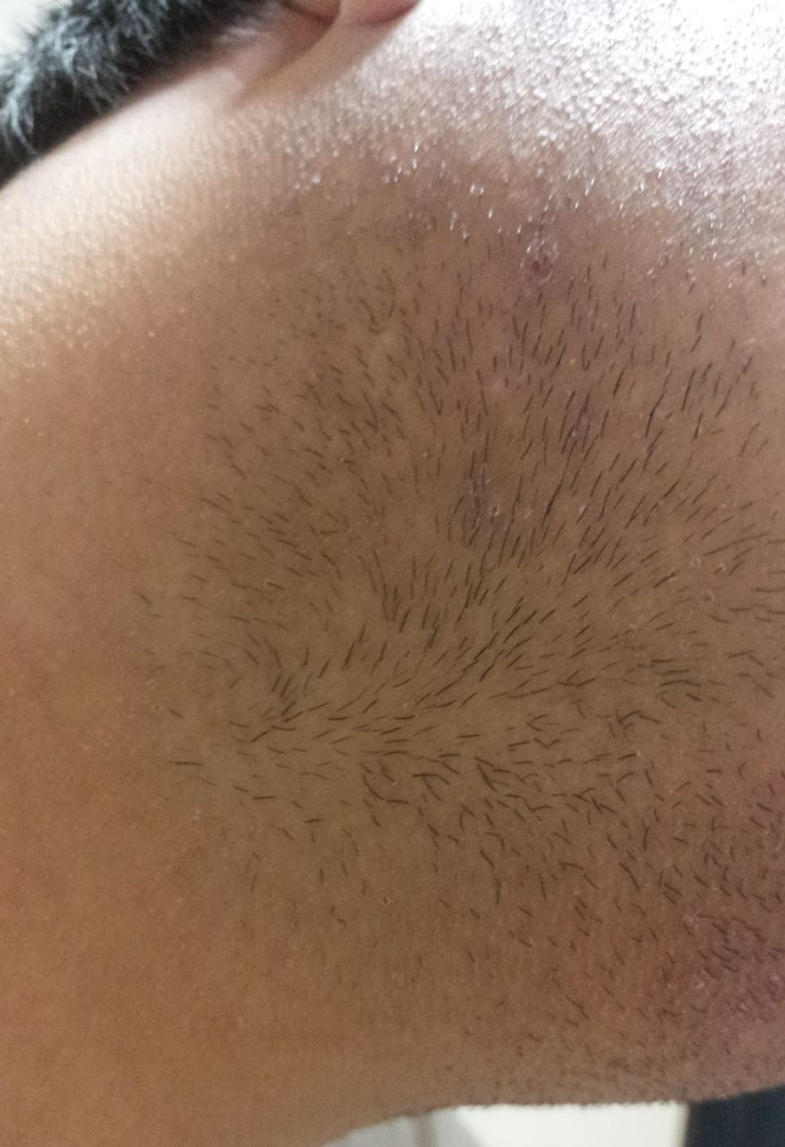 悲報 高校１年生なのに髭濃すぎる俺ｗｗｗｗｗｗｗｗｗｗ 腹黒速報