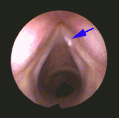 leukoplakia