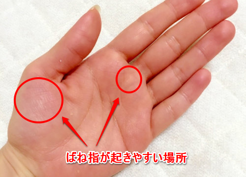 痛み 手のひら 手のひらの内出血は病気のシグナル？