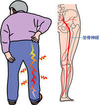 坐骨神経痛