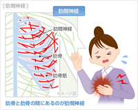 肋間神経痛