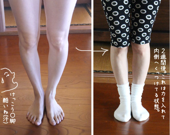 O脚を解消するnhkあさイチ紹介方法を実践 幼少期からo脚の効果は Good Life