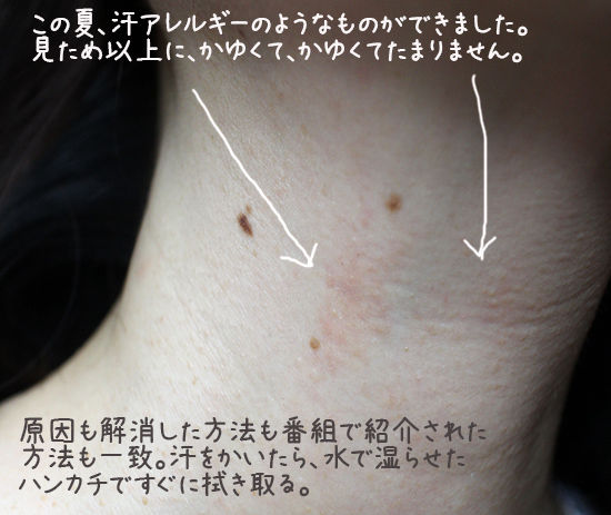 夏秋の湿疹 首など あせもと間違えやすいので注意 Nhkあさイチ Good Life