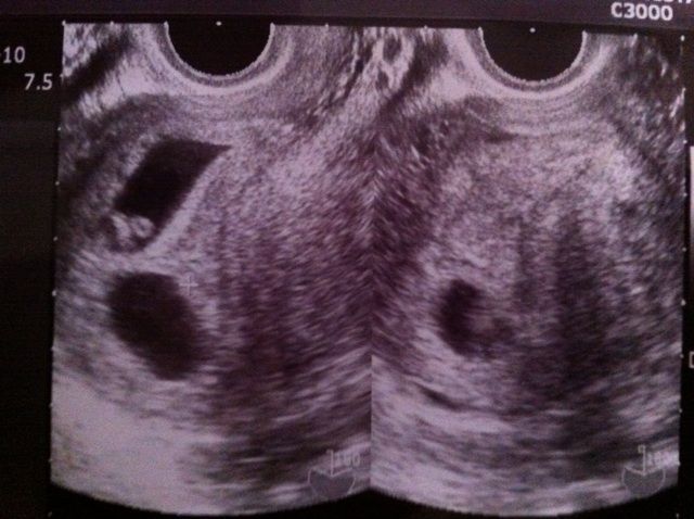 妊娠6 7週 心拍確認 Haru Babymaru 双子ママblog