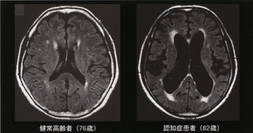 MRI