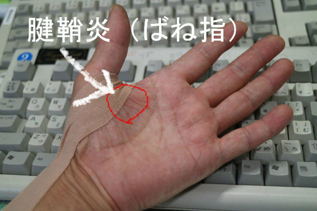 腱鞘炎 ばね指 えんどう豆日記 腱鞘炎 ばね指 えんどう豆日記