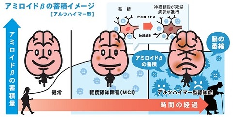 認知症にならないために、ちゃんと歯を磨こう