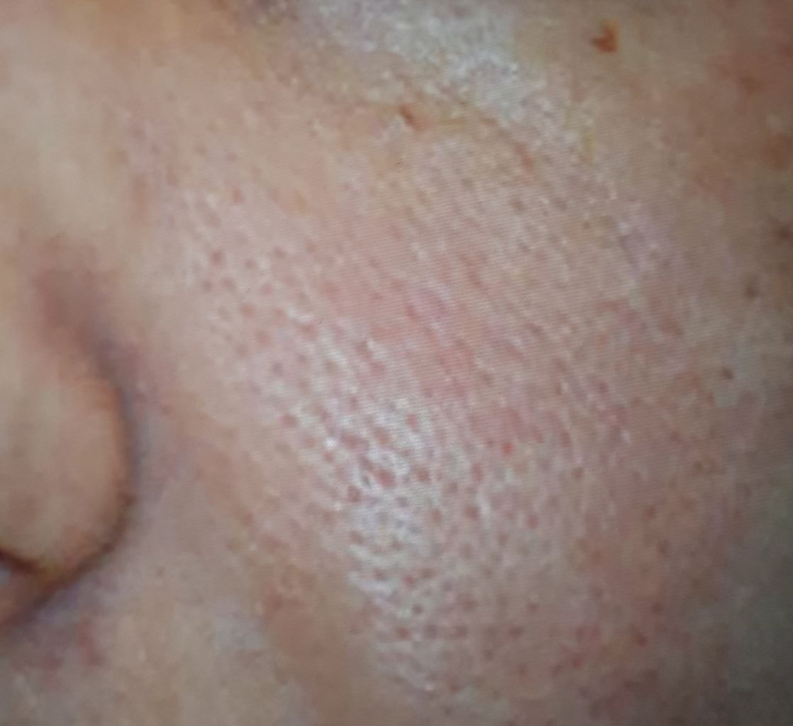 毎日コツコツ たるみ毛穴 を徹底ケア モイスティーヌ平和台サロンオーナーのブログ