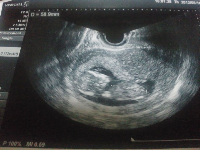 １２w４d 妊婦検診 無事に出産できるかな