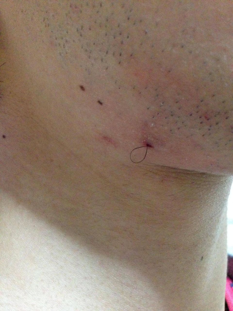 閲覧注意 2ヶ月放置した埋没毛カッターで引っこ抜いたｗｗｗ 日々なんちゃら速