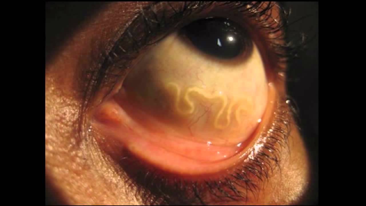 閲覧注意 寄生虫とかウイルス怖すぎワロタ 日々なんちゃら速