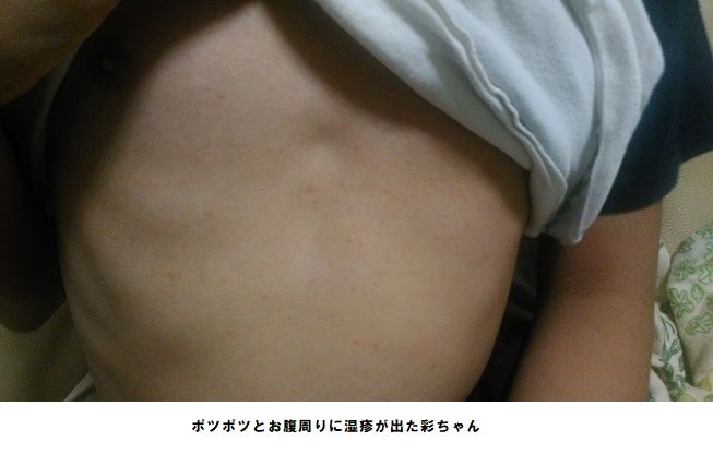 湿疹 お腹 周り 子供の湿疹には正しい理解を！顔やお腹に出る湿疹、熱やかゆみの症状や薬の選び方【小児科医監修】