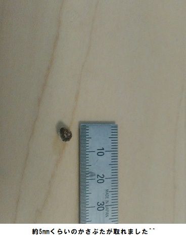 足のイボのかさぶた ポロリ ゆるーりらいふ家族日記