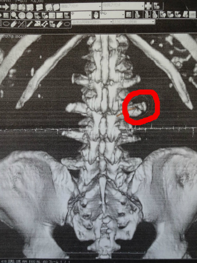 第３腰椎横突起骨折 右側 ひかり治療室 接骨院鍼灸院
