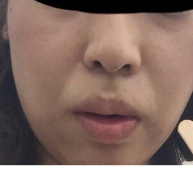 たるみ ほうれい線をなくすスレ Himajyoのまとめ 美容 ダイエット ファッション エンタメ 女子のための2chまとめ たるみ ほうれい線をなくすスレ Himajyoのまとめ 美容 ダイエット ファッション エンタメ 女子のための2chまとめ