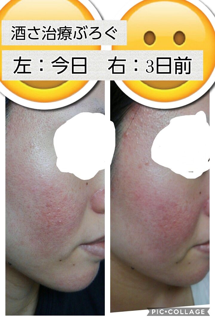 治療記録約３ヶ月目 酒さ治療ぶろぐ始めました