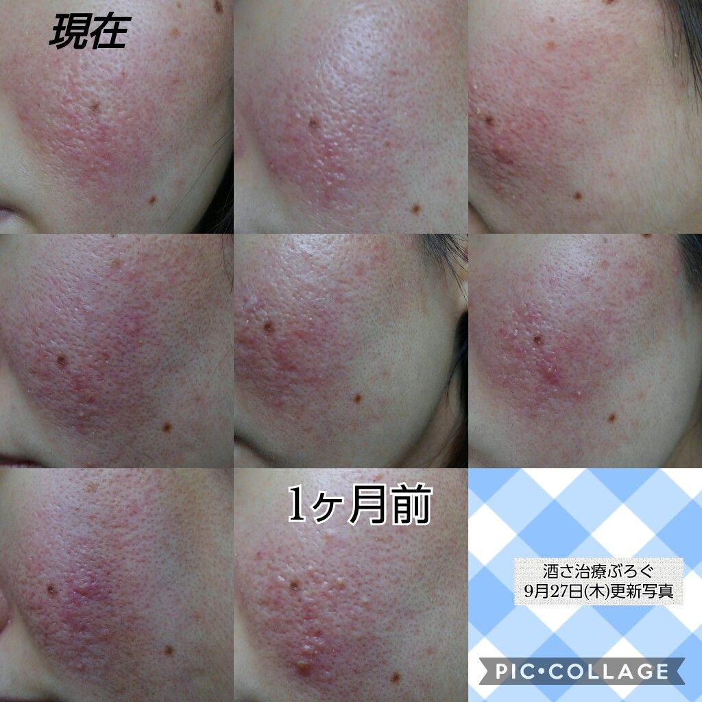 女医がいる皮膚科に行ってきた話 現在の状態 酒さ治療ぶろぐ始めました 女医がいる皮膚科に行ってきた話 現在の状態 酒さ治療ぶろぐ始めました