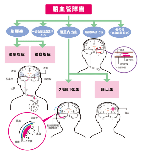 脳血管障害 未来の姿絵は光か闇か 只今 脳の修復作業中