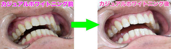 きれいな歯の前後