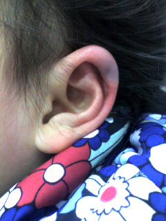2才でカリフラワーイヤー Private Opinion Hirolink S Blog