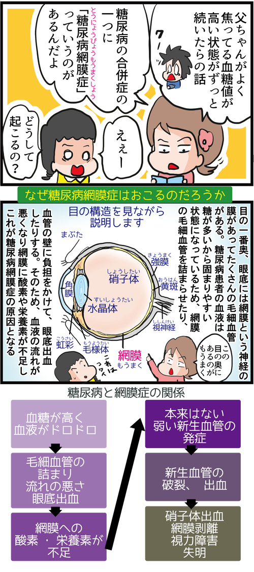 【血糖コントロール】失明の危険も!糖尿病網膜症ってどんなの?!3