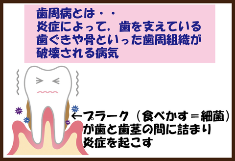 糖尿病と歯周病4