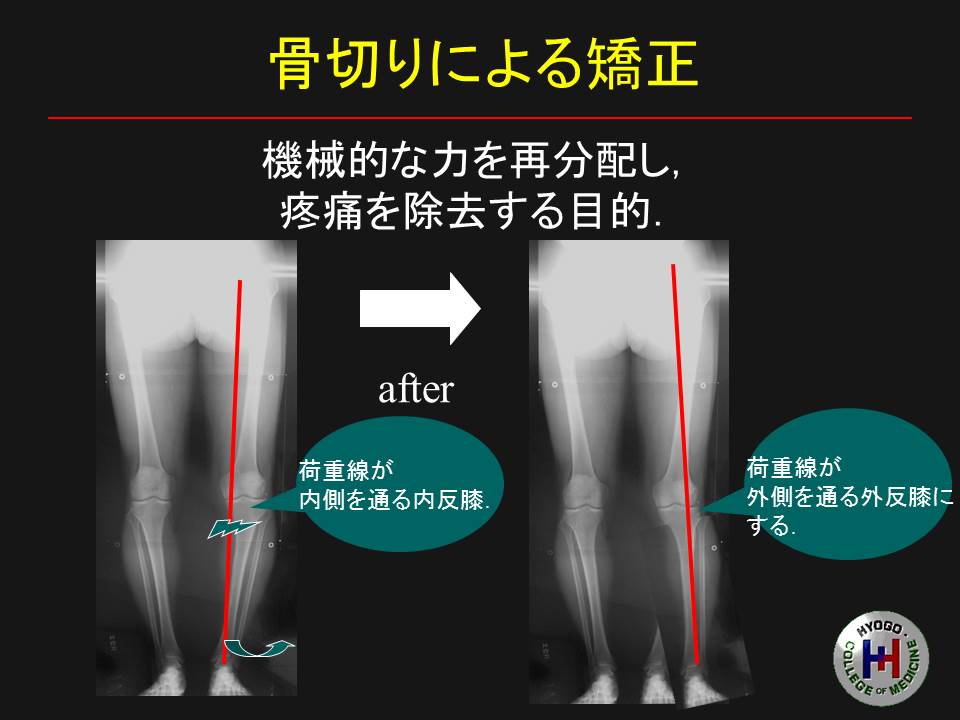 高位脛骨骨切術（変形性膝関節症について part 2） : 膝関節鏡