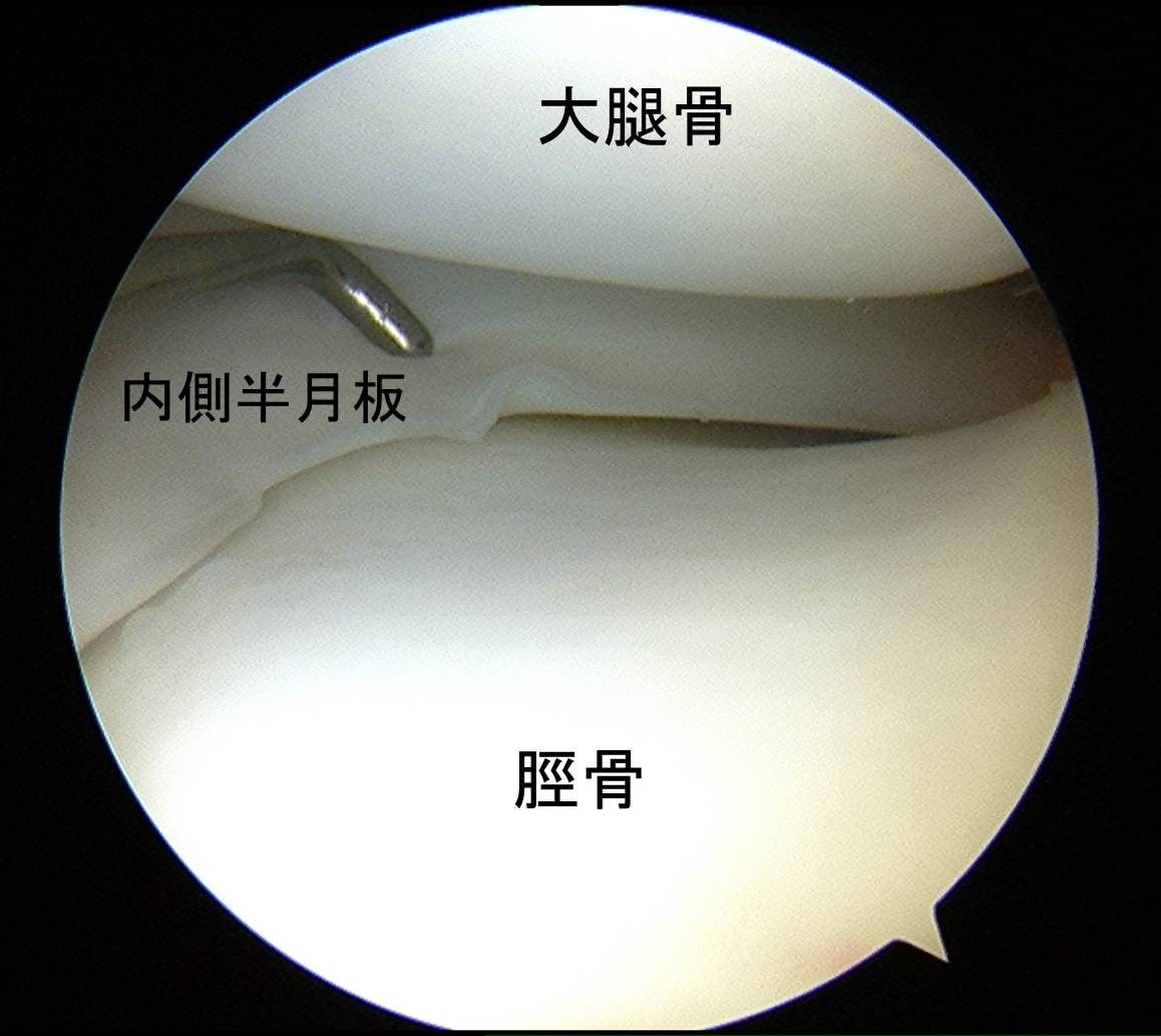 半月板損傷に対する縫合術 膝関節鏡外科医のblog 半月板損傷に対する縫合術 膝関節鏡外科医のblog