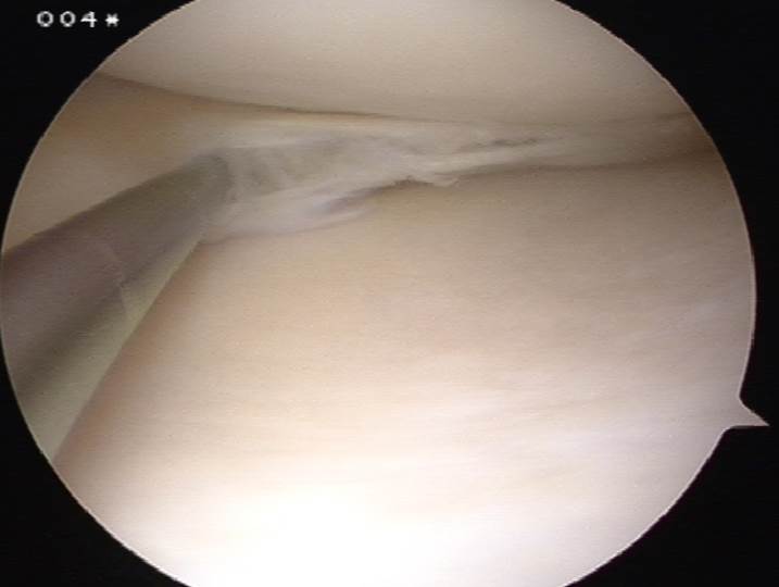 内側半月板水平 変性 断裂の治療 膝関節鏡外科医のblog