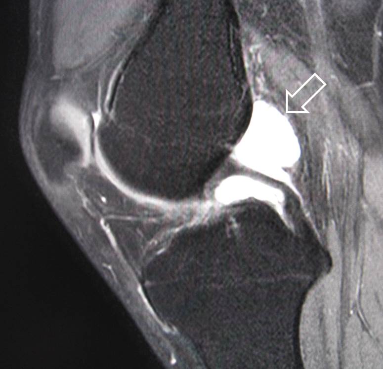大きく切開する手術は嫌ですよね 膝関節ガングリオンに対する関節鏡手術 Trans Septal Approach 膝関節鏡外科医のblog