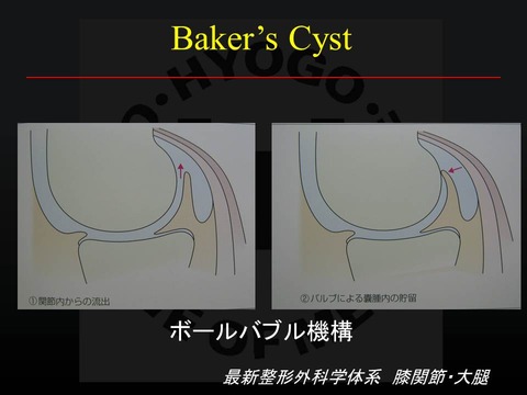 山下孝　poplyteal cyst5