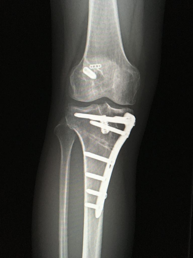 前十字靭帯再々建術と高位脛骨骨切り術をさせていただいた患者さんからのお便り 膝関節鏡外科医のblog