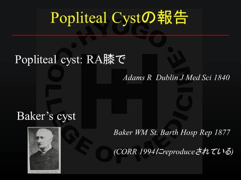 山下孝　poplyteal cyst2